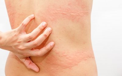 atopic dermatitis natural cures 